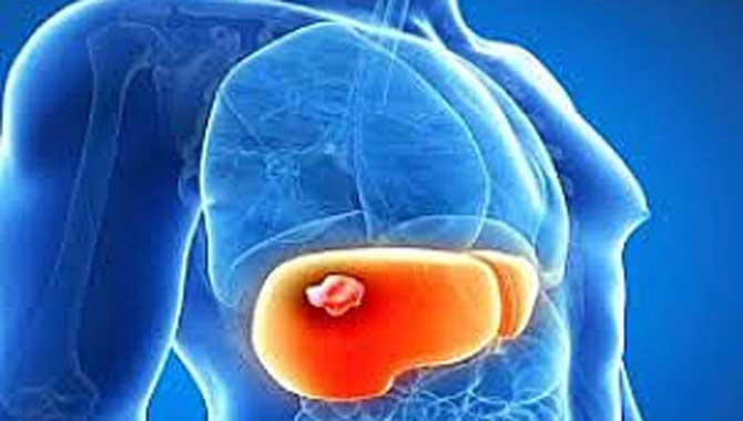 Karaciğer Tümörlerine Girişimsel İşlemlerle Nokta Atışı