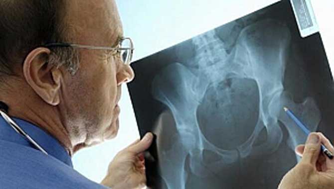 KEMİK ERİMESİNE BAĞLI KIRIKLAR HAYATİ TEHLİKEYE YOL AÇABİLİR