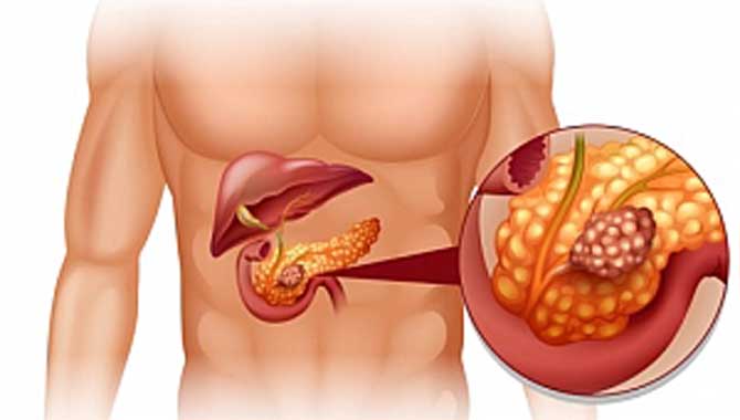 3 KUŞAK PANKREAS KANSERİ!