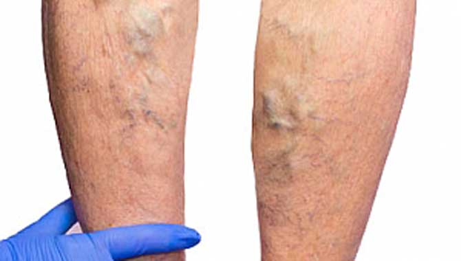 Bahar Aylarında Varis Tedavisi 