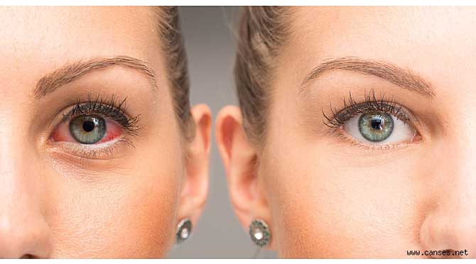 CORONAVIRUS (KORONAVİRÜS)’TEN KORUNMAK İÇİN GÖZLERİNİZE DİKKAT