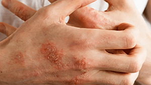 EL DEZENFEKTANLARI EL EGZAMASINA NEDEN OLABİLİR