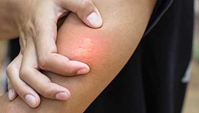 BÖCEK, SİNEK VE ARI SOKMASINA DİKKAT!