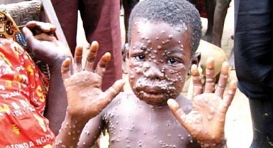 Maymun çiçeği virüsü durdurulamıyor! 